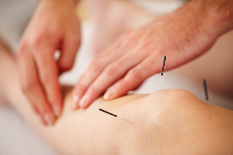 acupuncture, dry, needling IMS, sport, Village, Physio